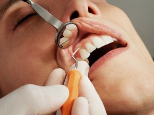 6 Signs That You May Have Gum Disease