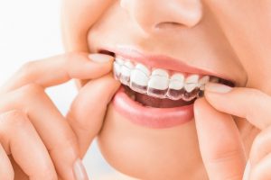 6 Tips To Get The Most From An Invisalign Treatment